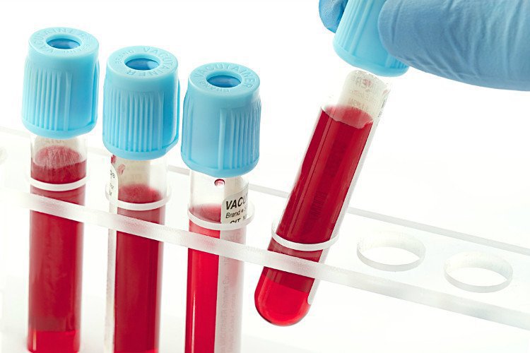 Tầm quan trọng của xét nghiệm tổng phân tích tế bào máu | Vinmec