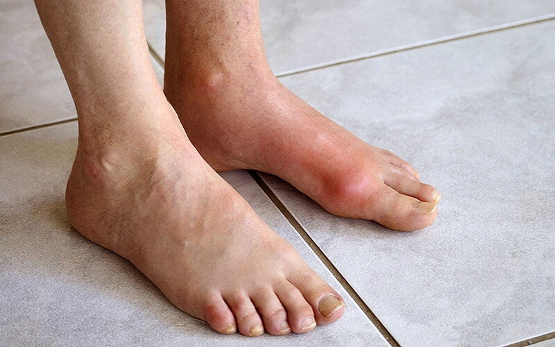 Bệnh Gout hay còn gọi là gút, thống phong, xảy ra ở các khớp ngón chân