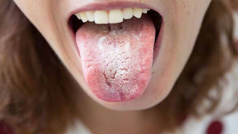 Dấu hiệu nhận biết trên miệng và thực quản