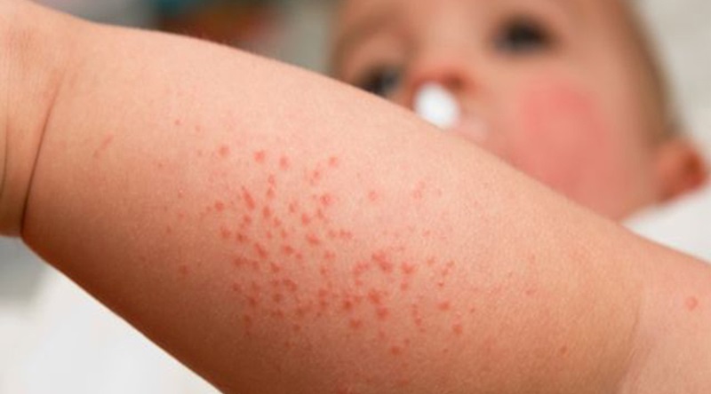 Những dấu hiệu nhận biết người bị bệnh sốt xuất huyết