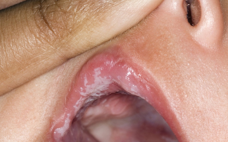 Tác hại khi trẻ bị nấm lưỡi, miệng