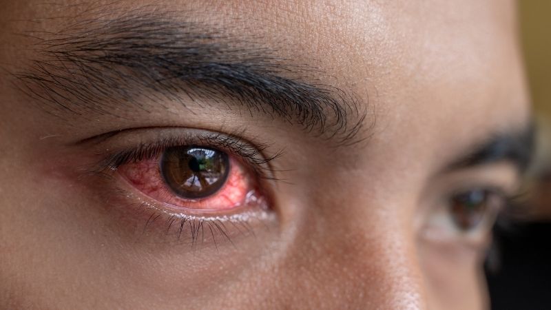 Những lưu ý khi bị đau mắt đỏ