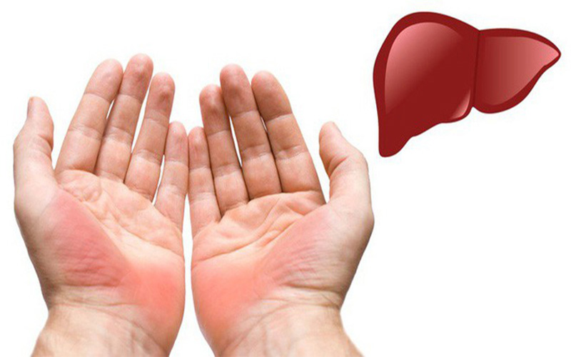 Lòng bàn tay màu đỏ hoặc ban đỏ có thể là dấu hiệu cảnh báo bệnh gan