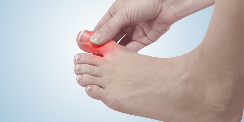 Triệu chứng đầu tiên của bệnh Gout là sưng đỏ và đau nhức ngón chân cái.