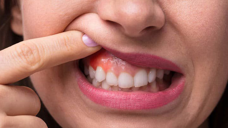 Viêm chân răng là sự tổn thương các tổ chức xung quanh răng và chân răng