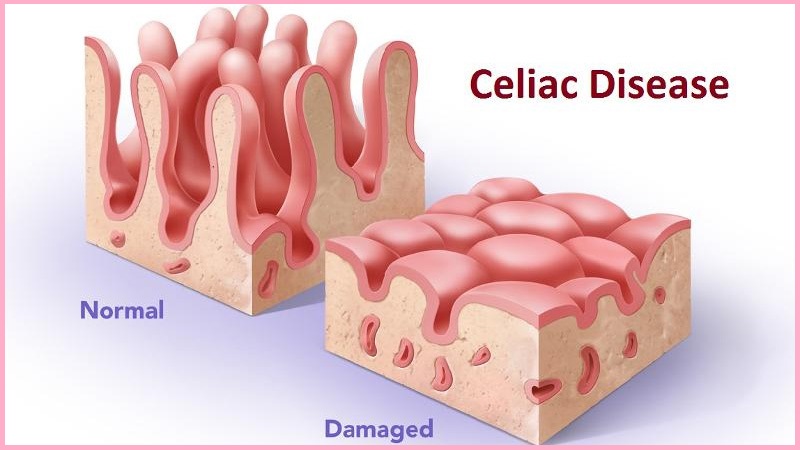 Nguyên nhân của bệnh Celiac