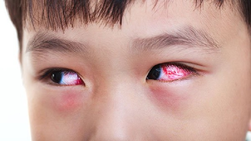 Dấu hiệu của bệnh đau mắt đỏ