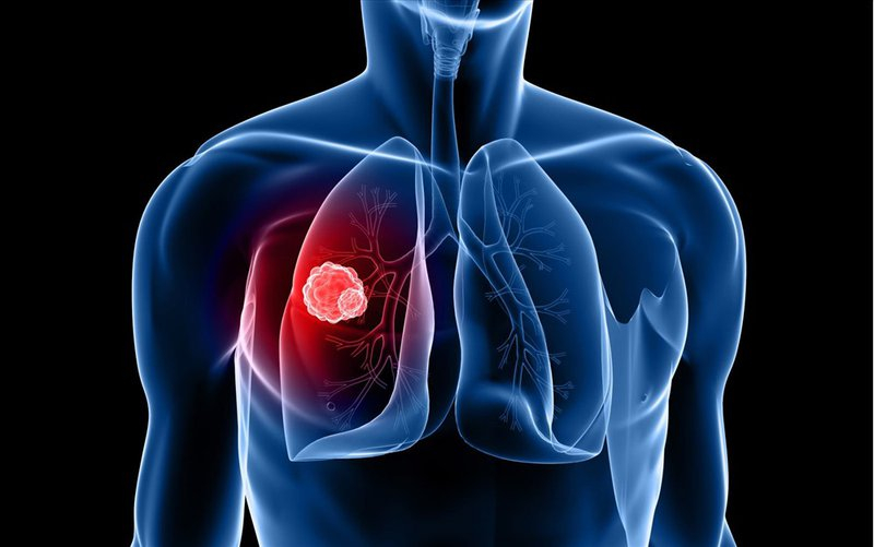 Tầm soát ung thư phổi