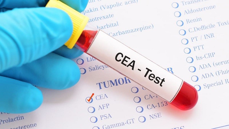 Xét nghiệm CEA là gì và cách đọc kết quả xét nghiệm - 7-Dayslim