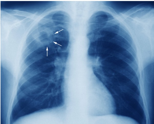 Xét nghiệm lao phổi là gì? Những xét nghiệm lao phổi phổ biến - 7-Dayslim
