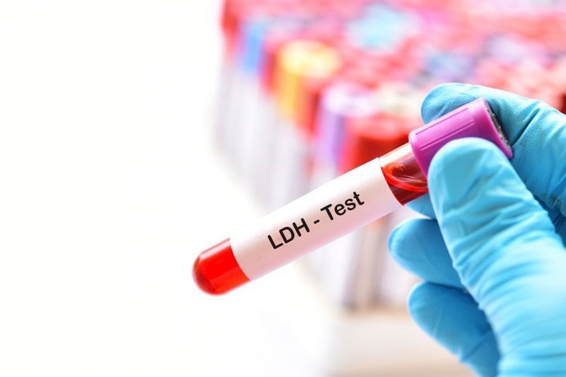 Xét nghiệm LDH là gì? Khi nào cần thực hiện xét nghiệm LDH? - 7-Dayslim