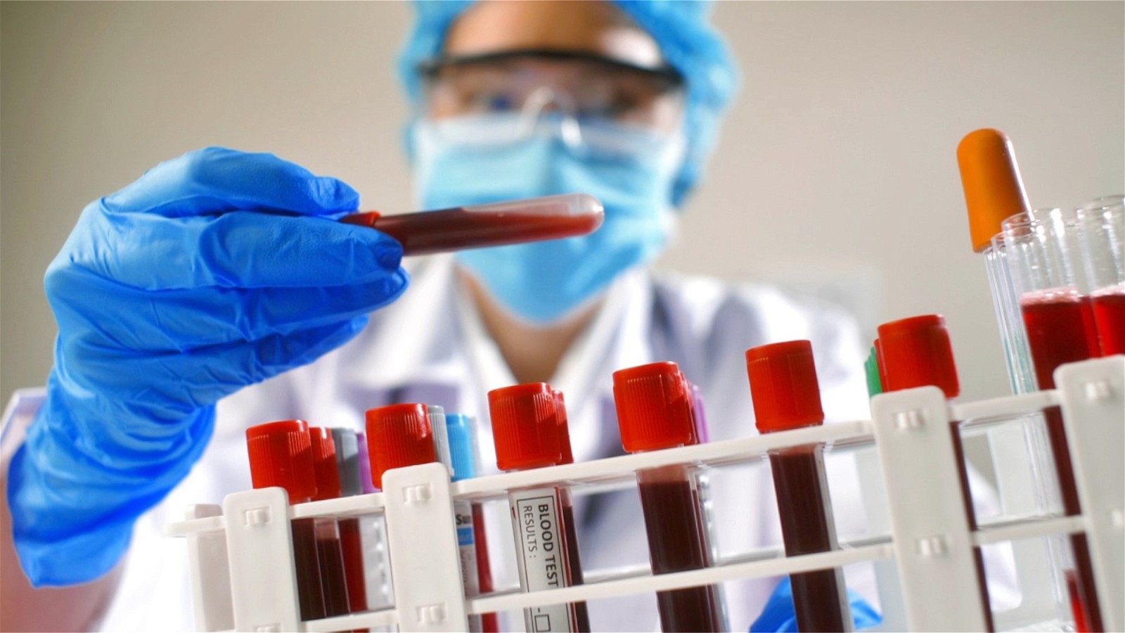 Xét nghiệm máu bao nhiêu tiền và thực hiện ở đâu nhanh, chính xác?