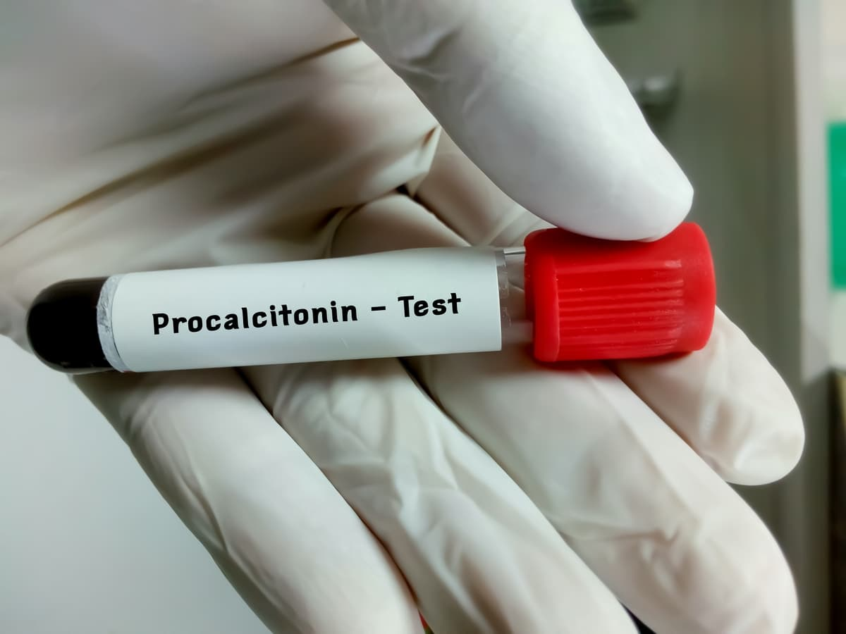 Xét nghiệm Procalcitonin có ý nghĩa gì? Quy trình và những lưu ý khi xét nghiệm - 7-Dayslim