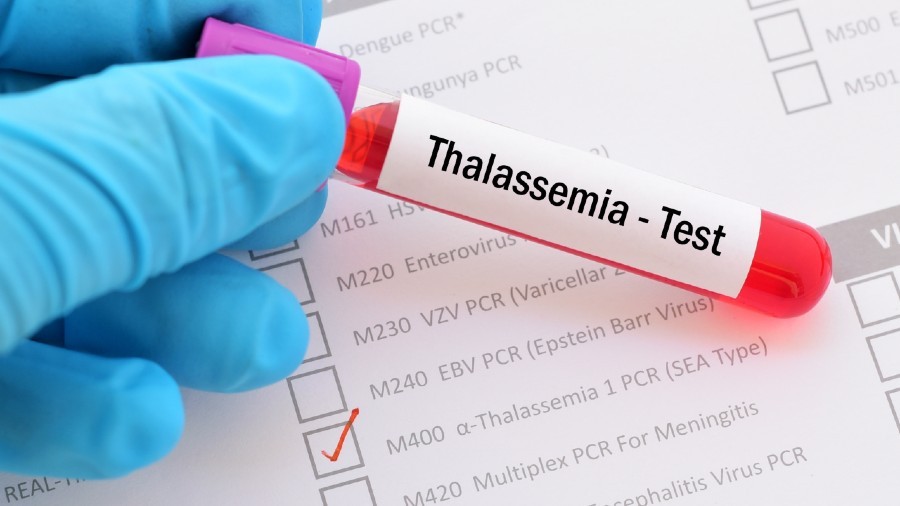 Xét nghiệm Thalassemia hết bao nhiêu tiền? Xét nghiệm Thalassemia ở đâu? - 7-Dayslim